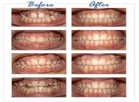 Orthodontic Teeth Correction Dental braces are appliances which are used to align or straighten the teeth and guide the teeth to the corrected position.